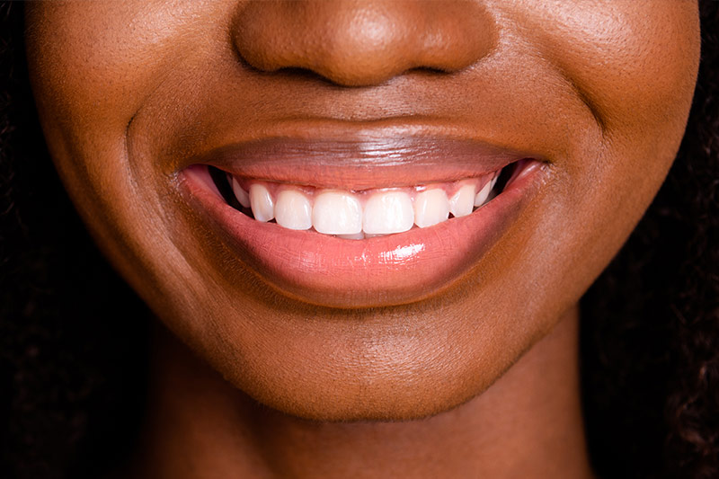 Smile Makeover in Milford