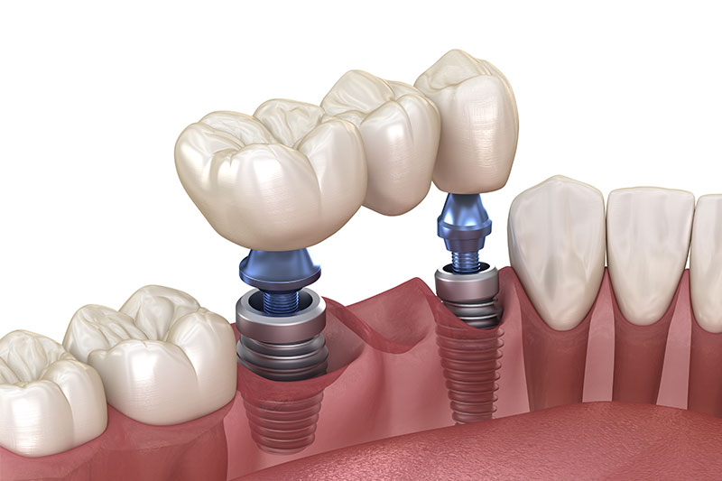 Dental Implants in Milford