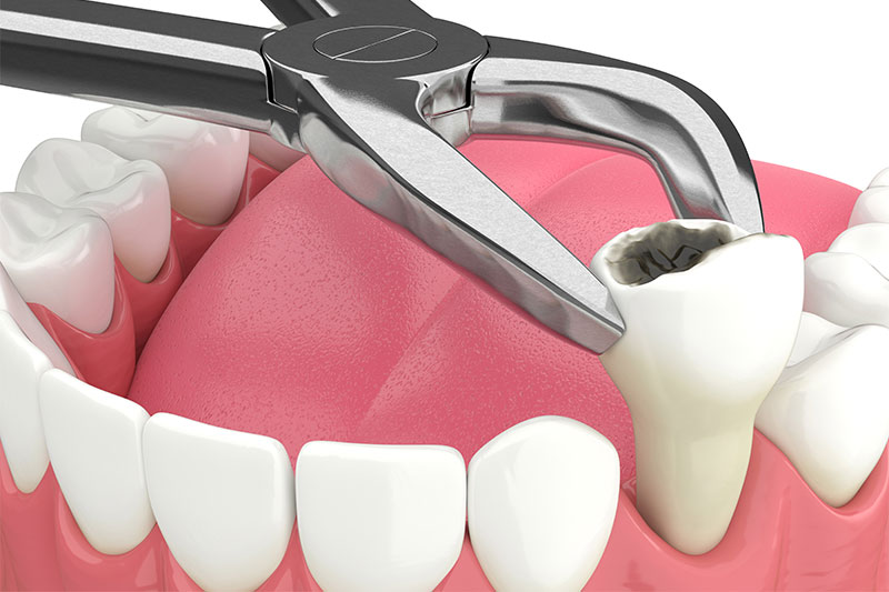 Single Tooth Extraction in Milford